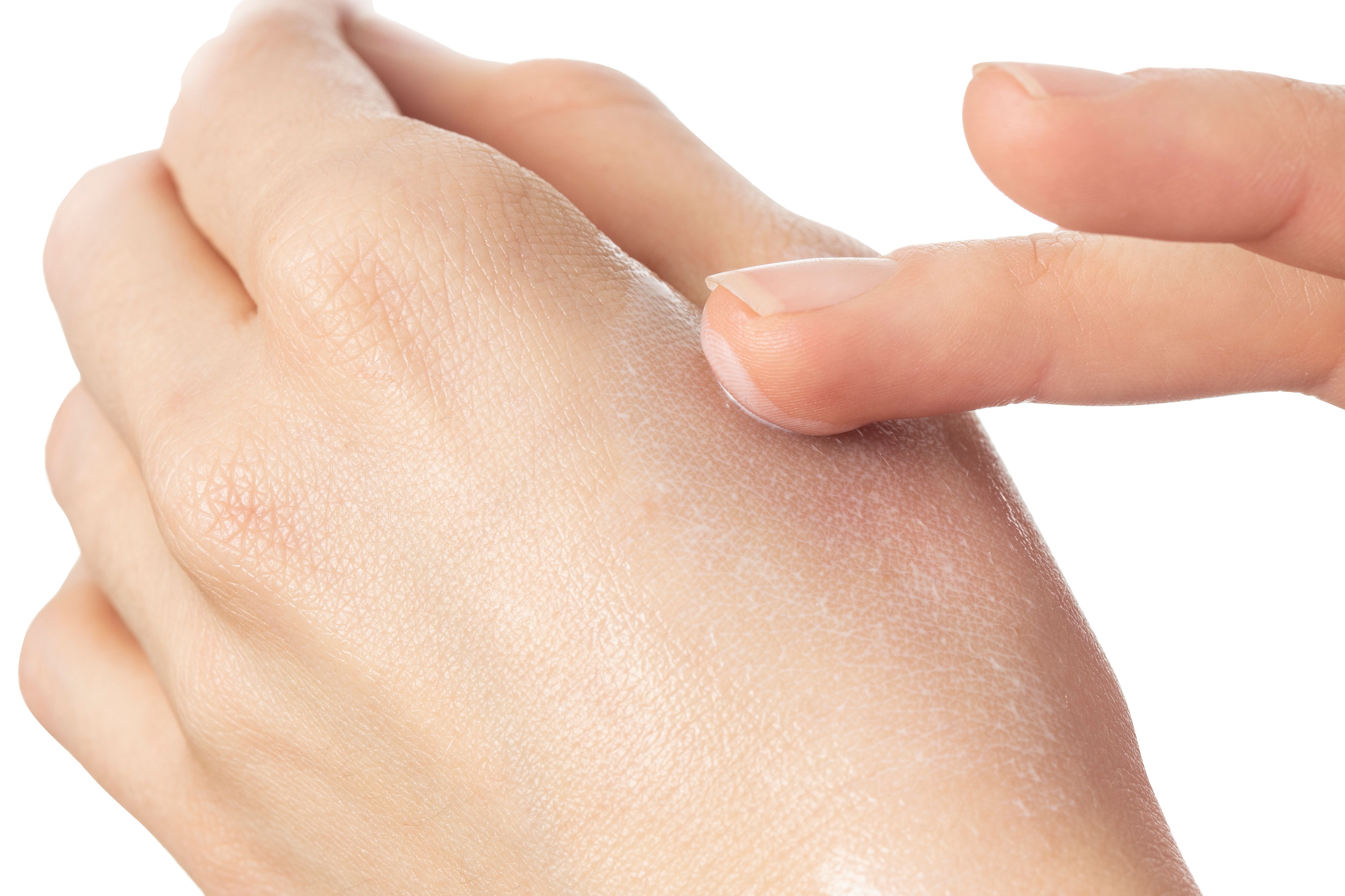 Primo piano di una mano che stende la crema sulla pelle. Crema sulla pelle.