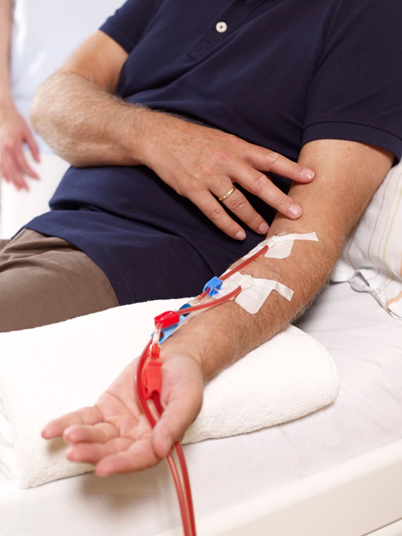 Braccio di un paziente con tubi medici fissati con nastro adesivo.