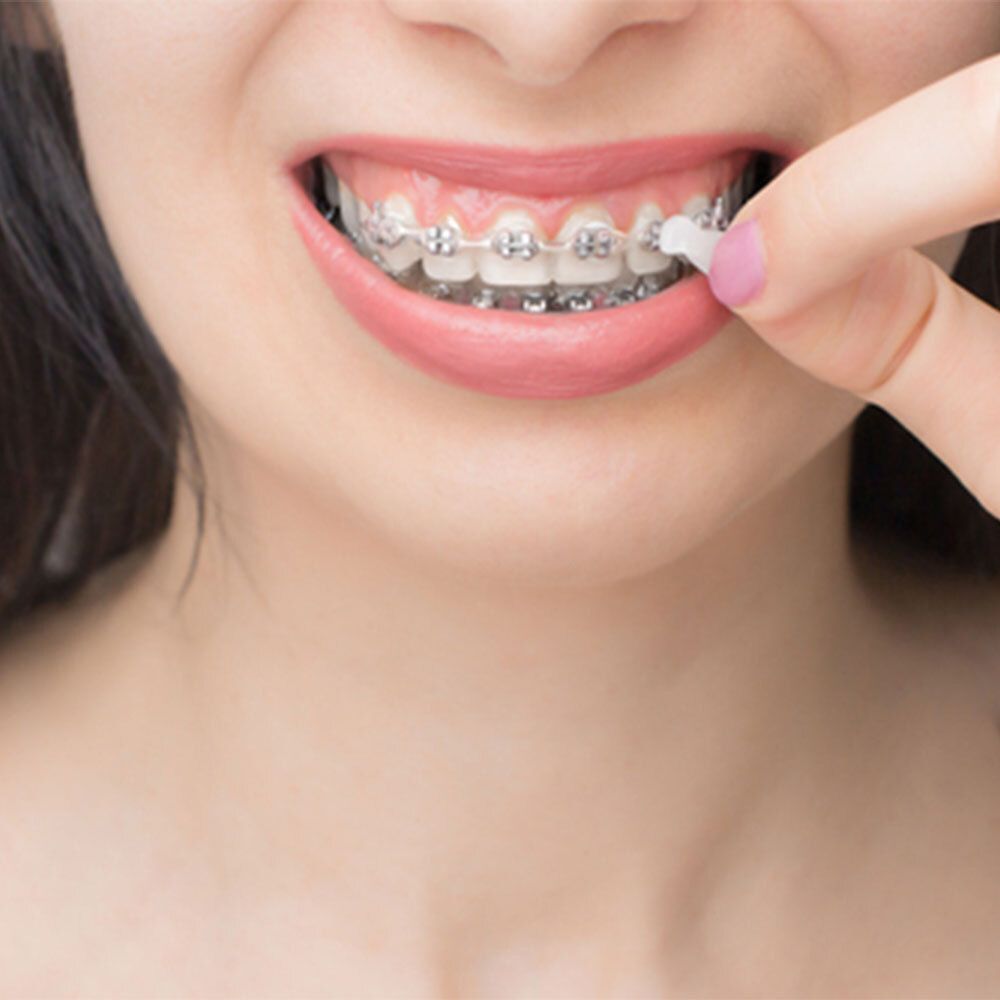 Bocca di una persona con apparecchio. Dito che tiene un pezzo di cera. Denti e apparecchio a fuoco.