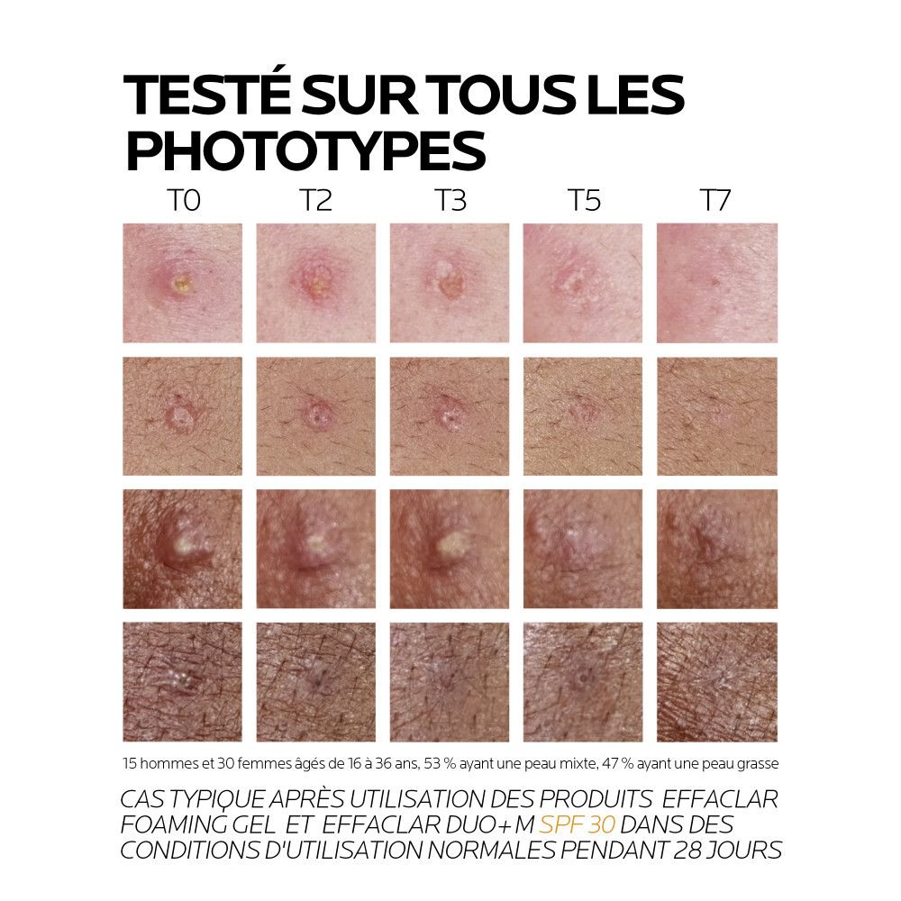 Immagini comparative di tipi di pelle prima e dopo l'uso di La Roche Posay Effaclar Duo+ M SPF 30.