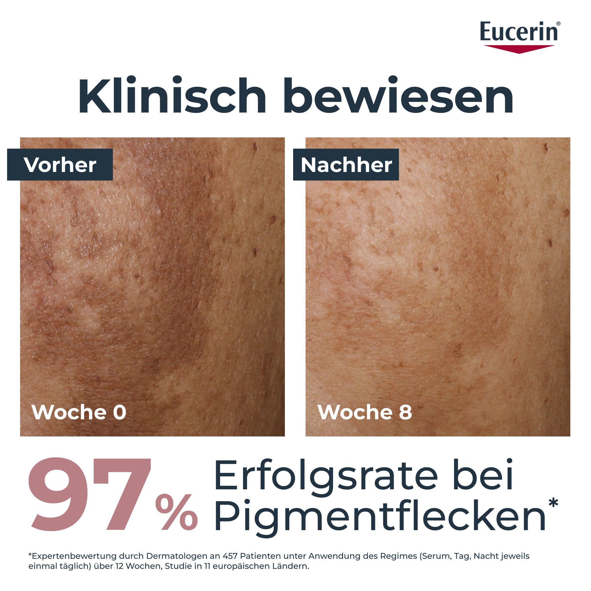 Confronto prima-dopo di pelle con macchie pigmentarie, mostra un tasso di successo del 97% con Eucerin Anti-Pigment.