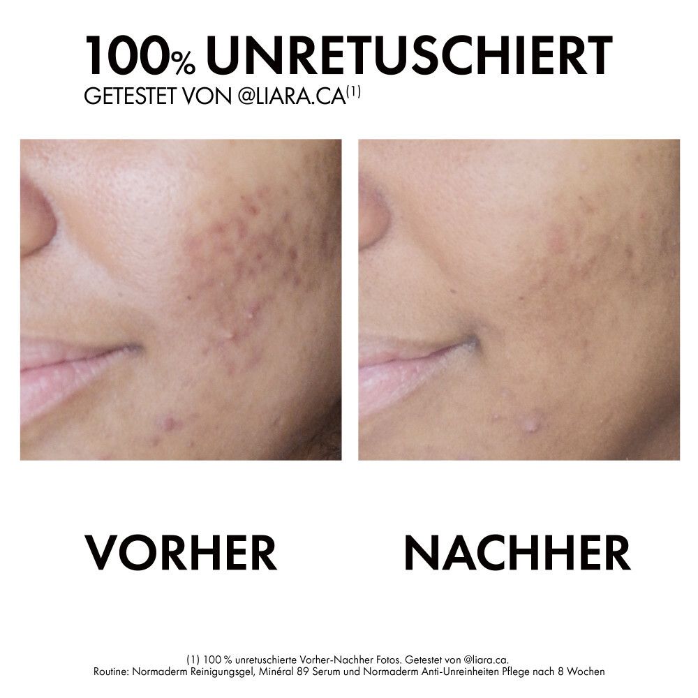 Confronto prima e dopo del trattamento dell'acne sul viso.