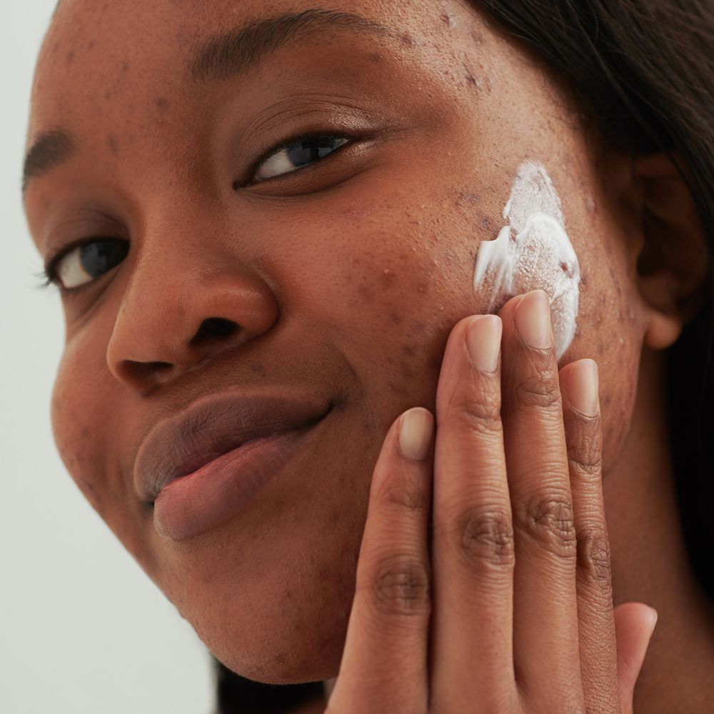 Persona che applica la crema sul viso. Pelle con imperfezioni. Crema chiara applicata.