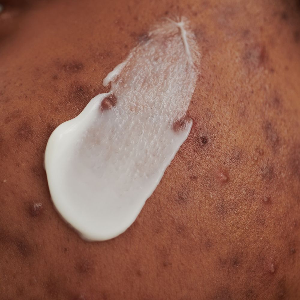 Primo piano della crema sulla pelle. Crema bianca su pelle scura. Imperfezioni cutanee visibili.
