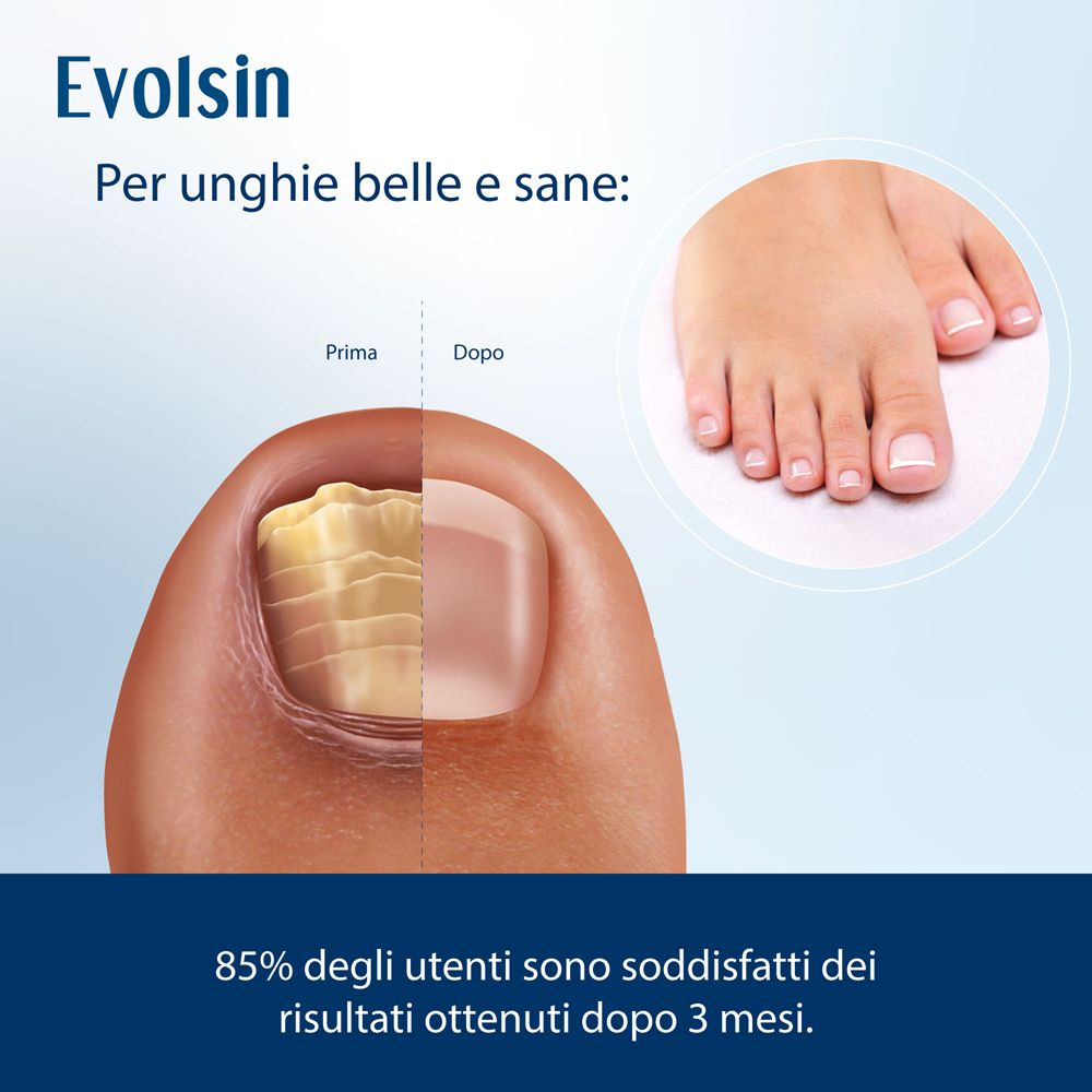 Infografica: il 90% dei pazienti riferisce un miglioramento del colore delle unghie. Evolsin.