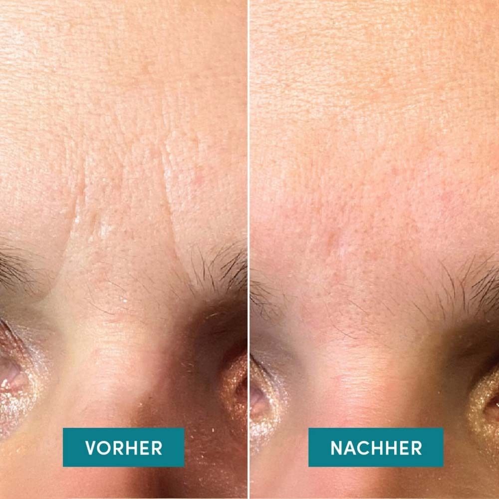 Confronto prima-dopo delle rughe della fronte. Due immagini affiancate.