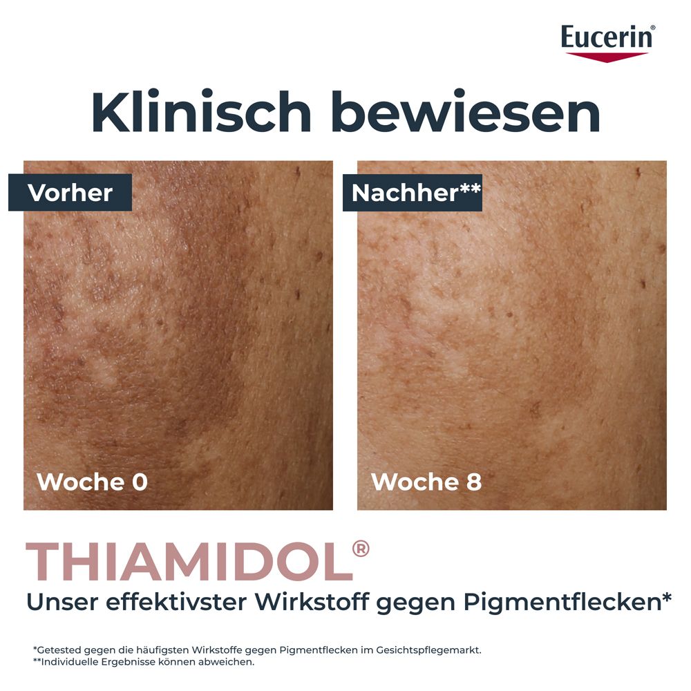 Confronto prima e dopo della pelle con macchie pigmentarie trattate con Eucerin Anti-Pigment.