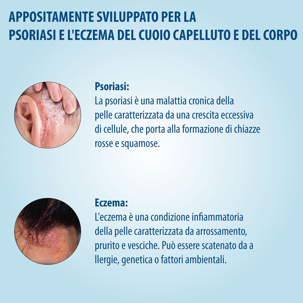 Informazioni su psoriasi ed eczema. Immagini di eruzioni cutanee. Descrizione dei sintomi e delle cause.