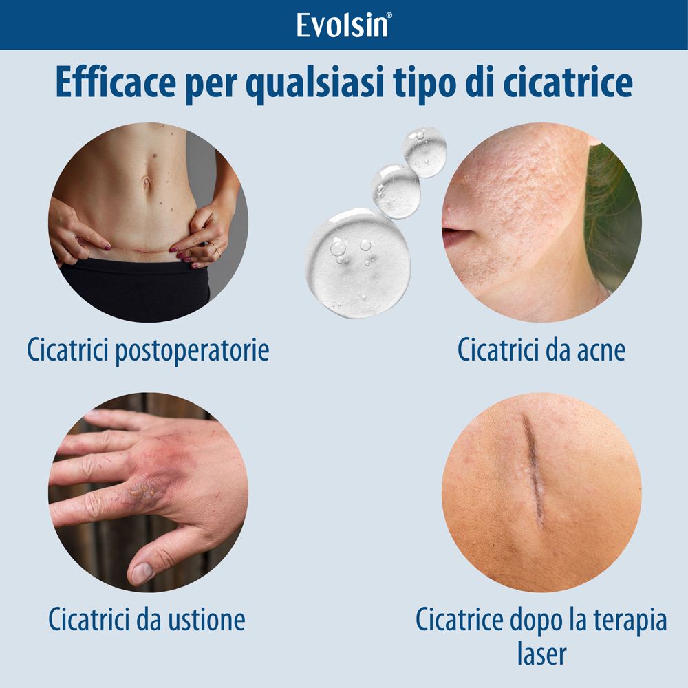 Grafico con diversi tipi di cicatrici. Post-operatorie, acne, ustioni, laser.
