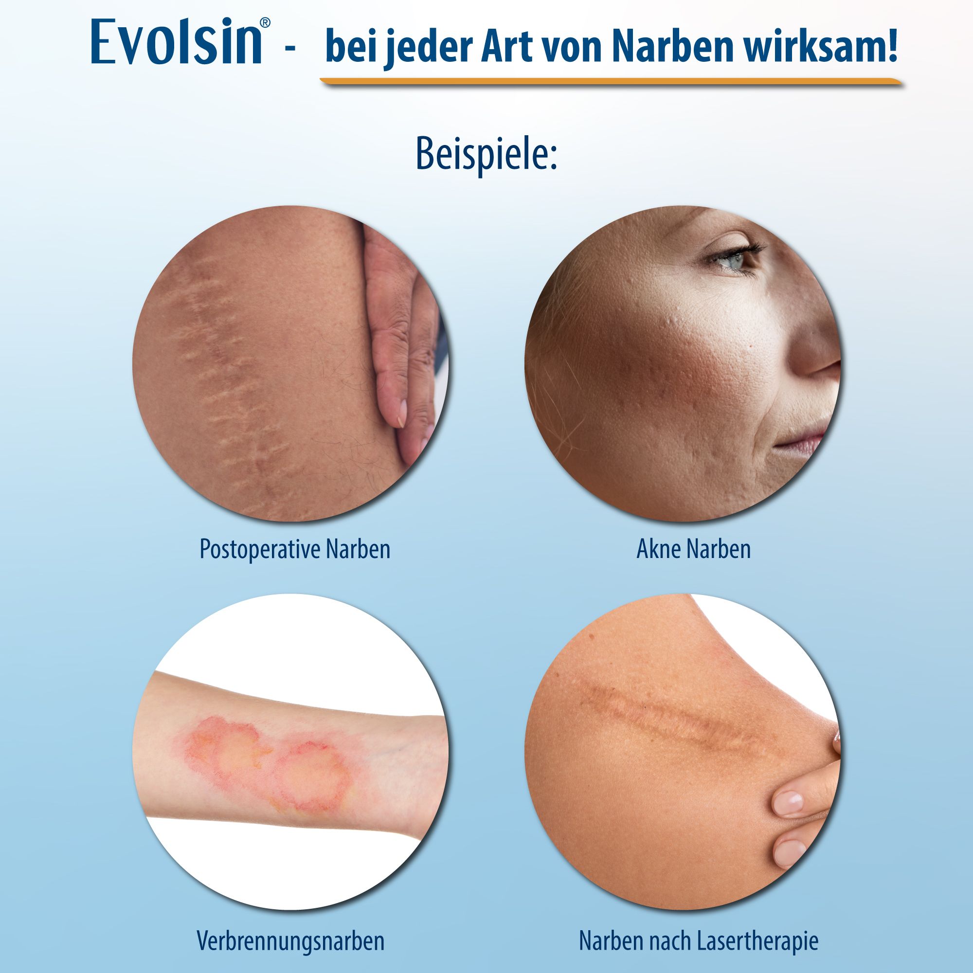 Esempi di cicatrici: operazioni, taglio cesareo, acne, ipertrofia, ustioni. Testo: Evolsin efficace su tutti i tipi di cicatrici.