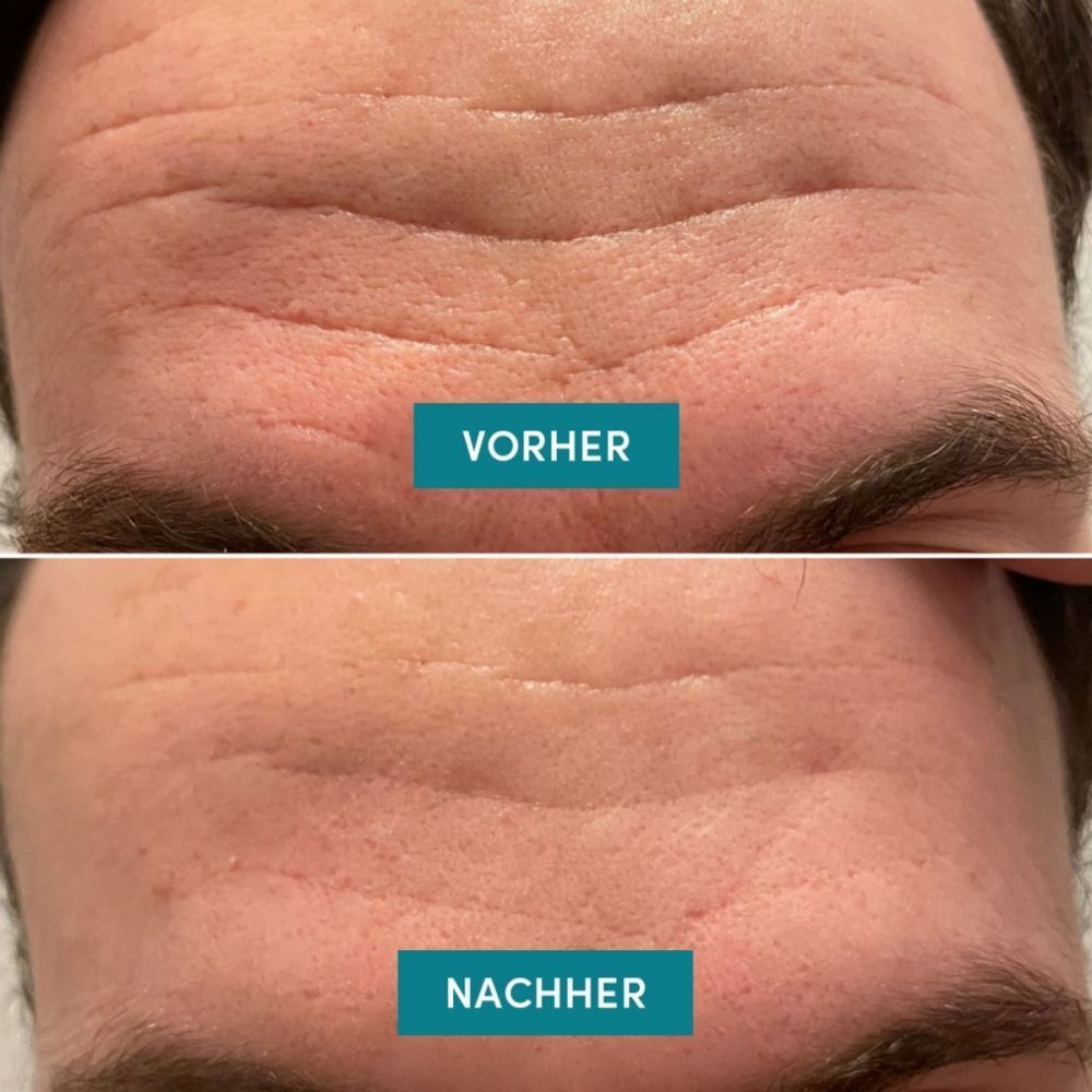 Confronto prima e dopo delle rughe sulla fronte, con e senza Patch Viso APRICOT.
