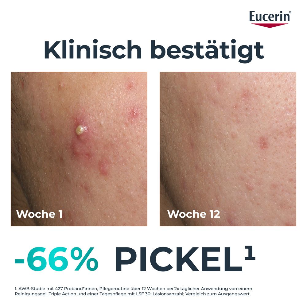 Immagini prima e dopo: pelle con brufoli nella settimana 1 e pelle migliorata nella settimana 12. Riduzione del 66% dei brufoli.