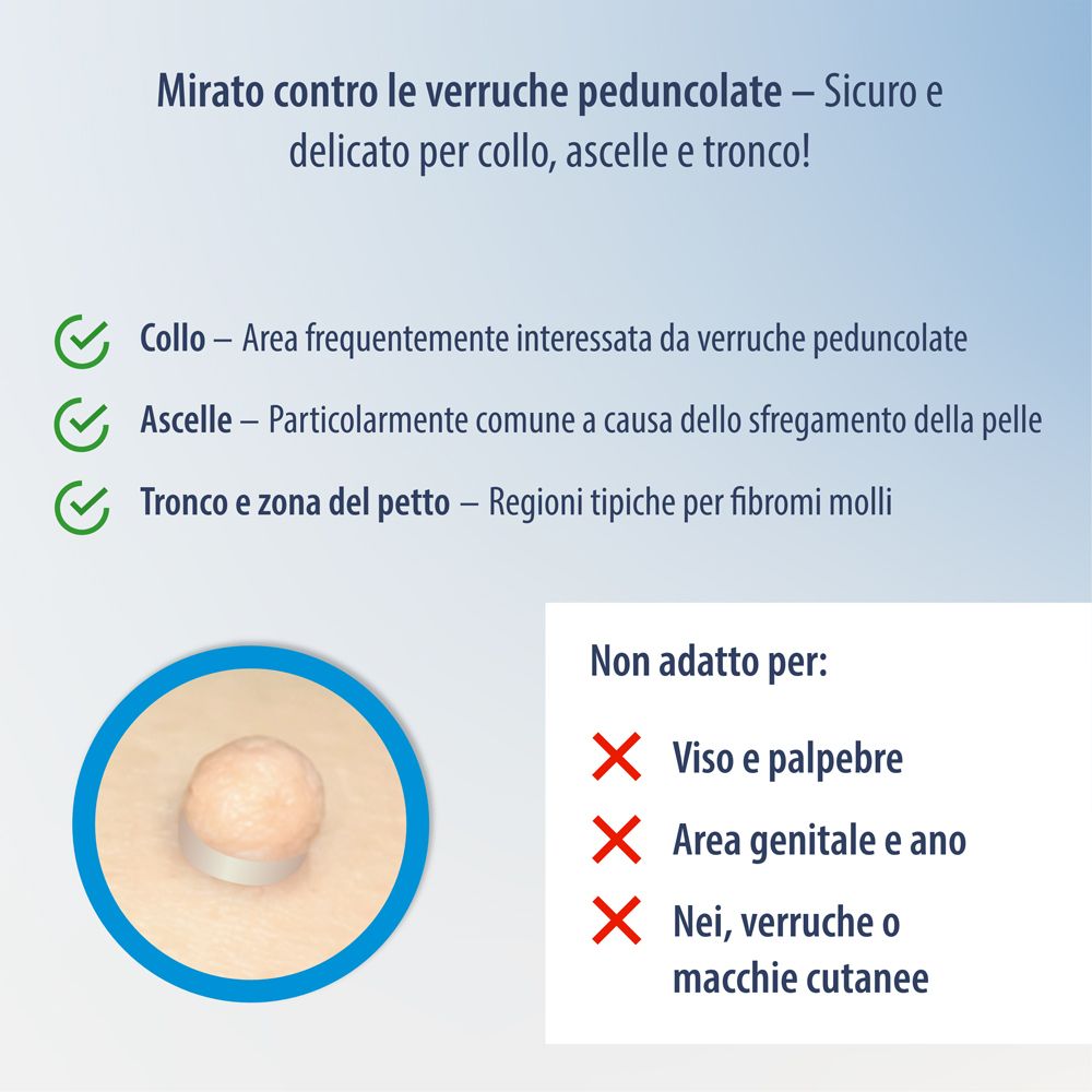Evolsin Anti Stielwarze: Interruzione del flusso sanguigno tramite anello in silicone. Metodo meccanico, senza chimica.