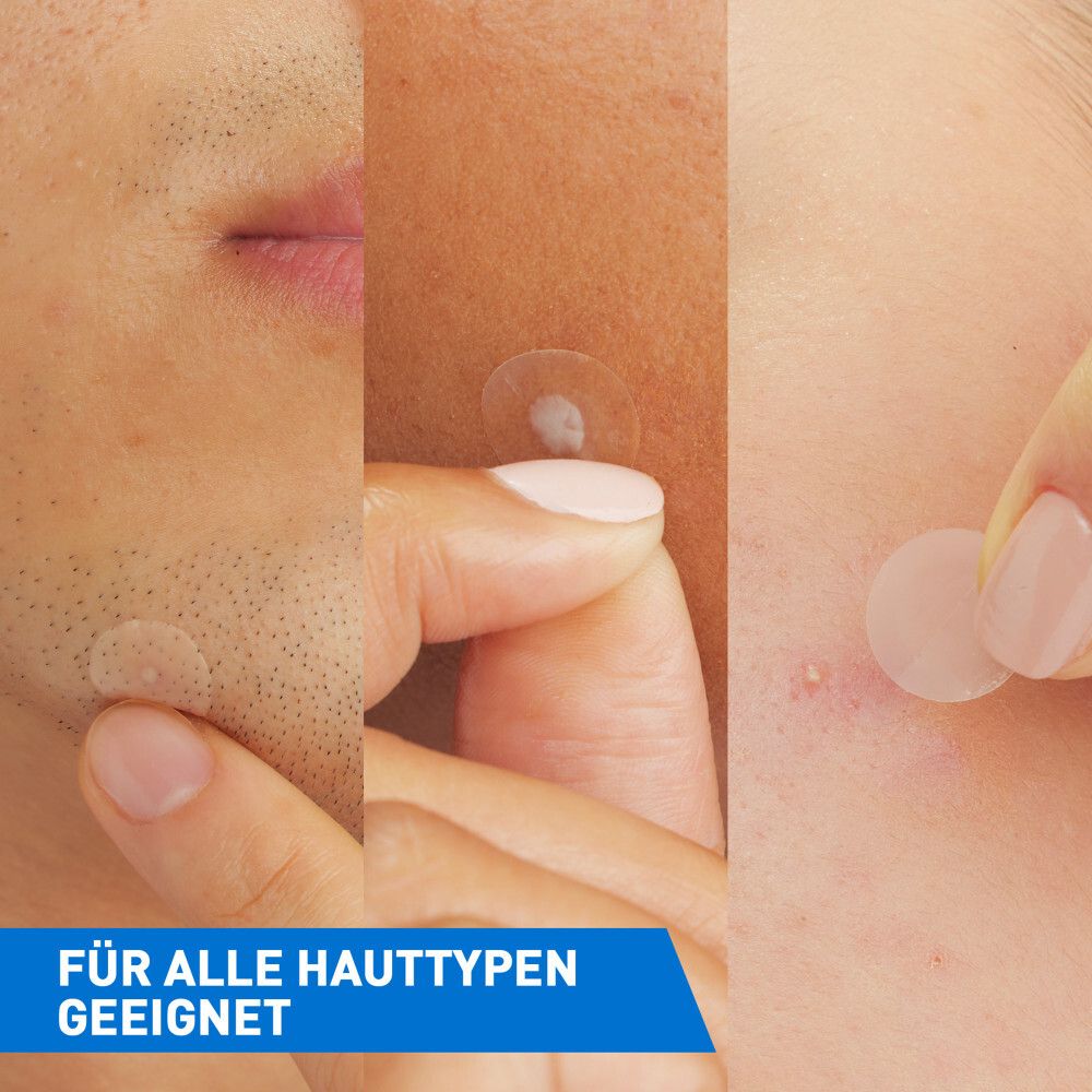 Applicazione di un patch su un brufolo. Pulire e asciugare delicatamente le imperfezioni. Coprire per 6+ ore.