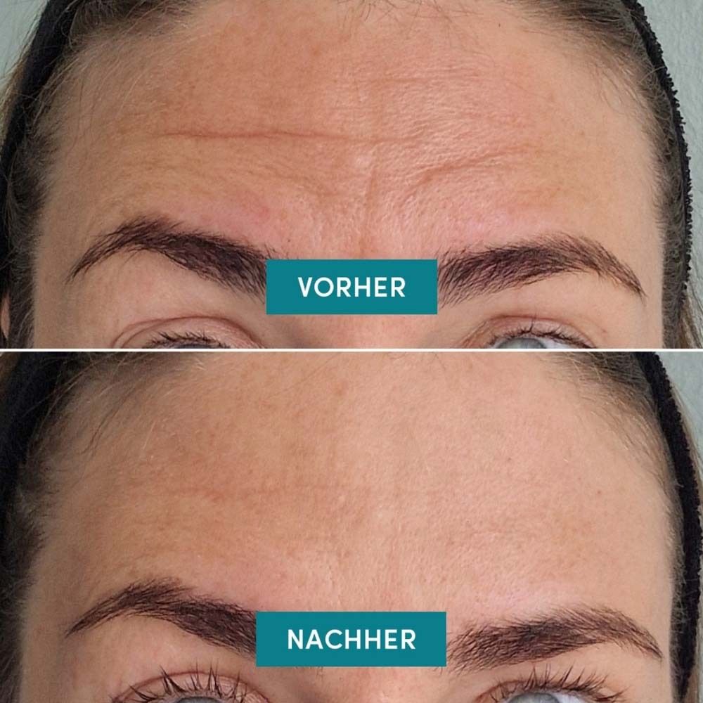 Confronto prima-dopo. Due foto di rughe sulla fronte. Sopra: Prima. Sotto: Dopo. Testo in turchese.