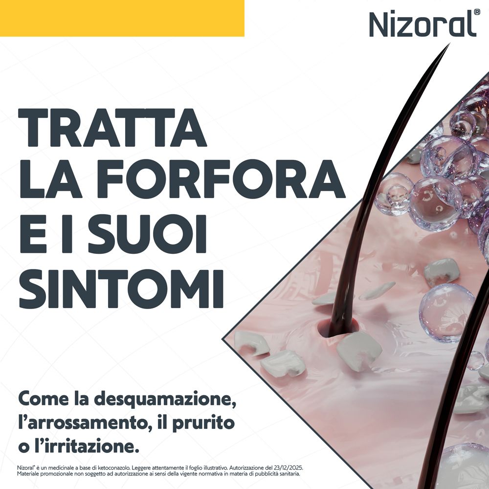 Primo piano di capelli e cuoio capelluto con forfora.