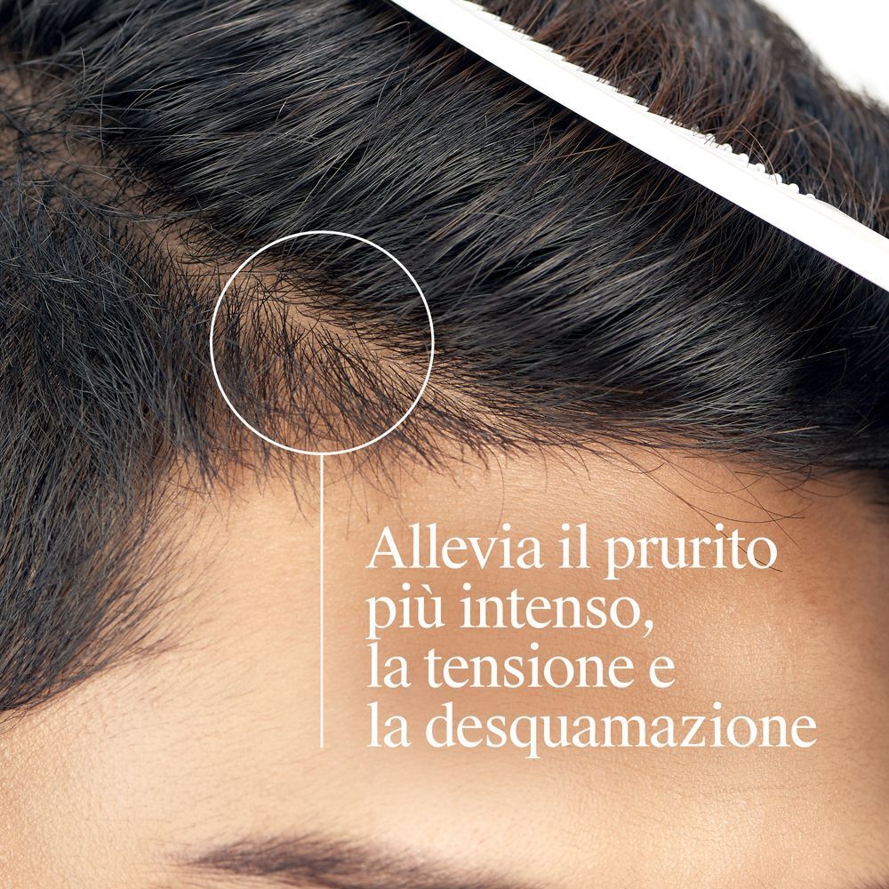 Primo piano di un cuoio capelluto con cerchio che indica prurito.