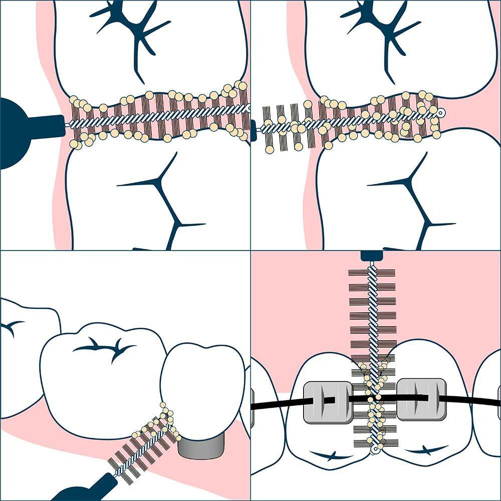 Illustrazione dell'uso di scovolini interdentali tra denti e apparecchi ortodontici.