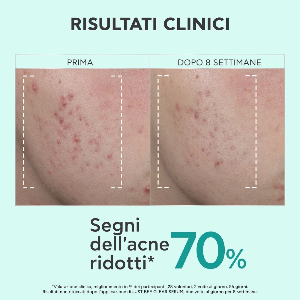 Confronto prima e dopo delle cicatrici da acne dopo 8 settimane. Testo in italiano.