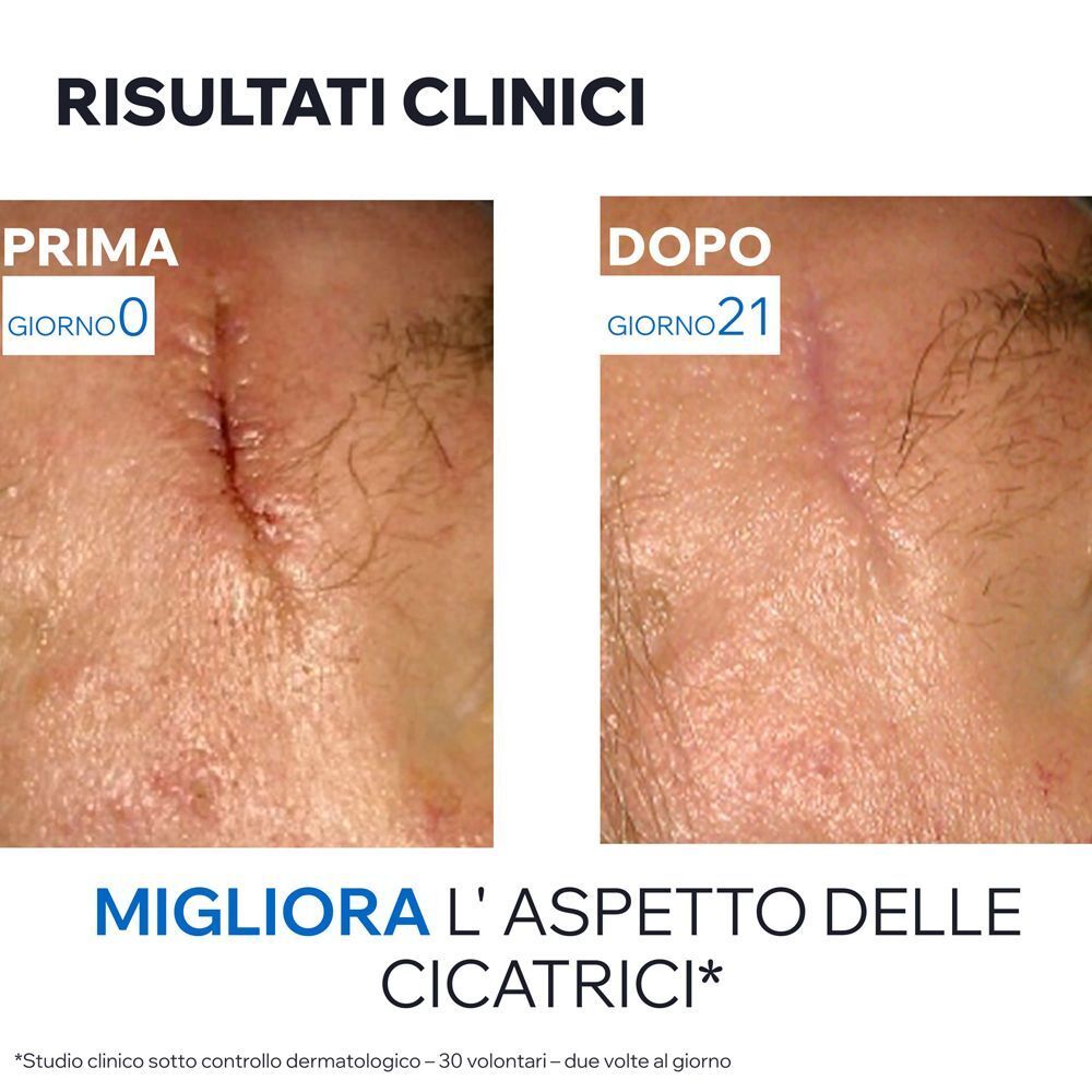 Prima/Dopo: Risultati clinici migliorano aspetto cicatrici in 21 giorni.