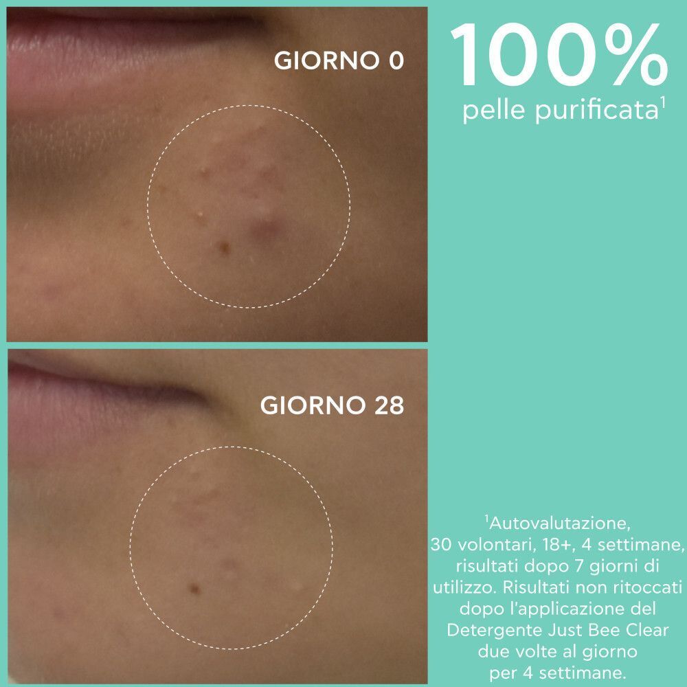 Confronto prima/dopo: pelle prima e dopo 28 giorni di uso del Gel Apivita Just Bee Clear.
