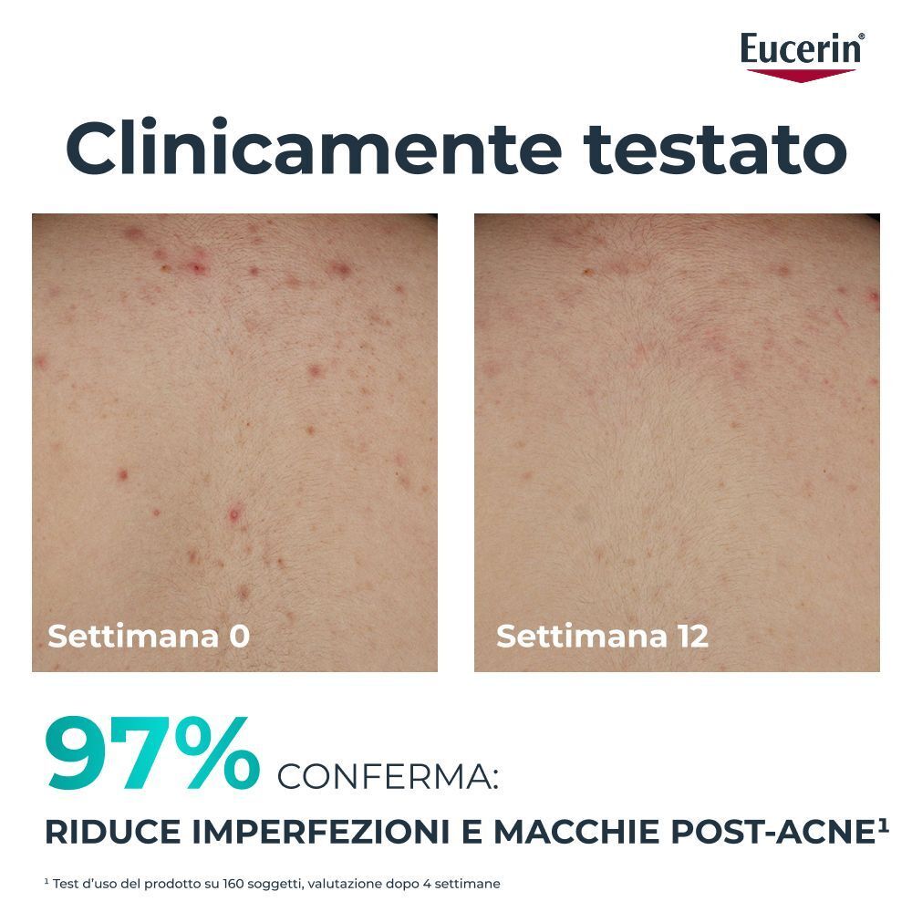 Aspetto della pelle prima e dopo 12 settimane di trattamento Eucerin Dermopure.