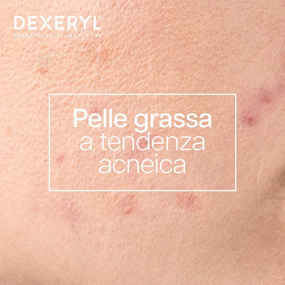 Primo piano di pelle a tendenza acneica con testo 'Pelle grassa a tendenza acneica'.