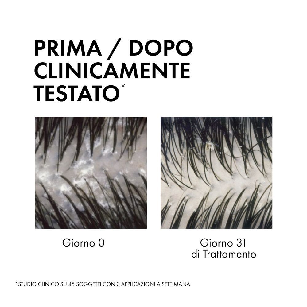 Immagini prima e dopo del cuoio capelluto che mostrano l'efficacia dello shampoo antiforfora Vichy Dercos.