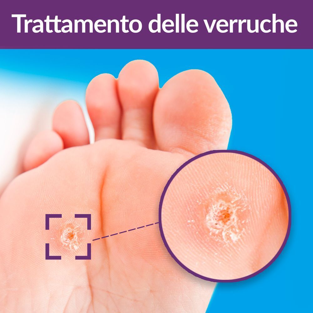 Primo piano di una verruca sul piede trattata con EXCILOR®.