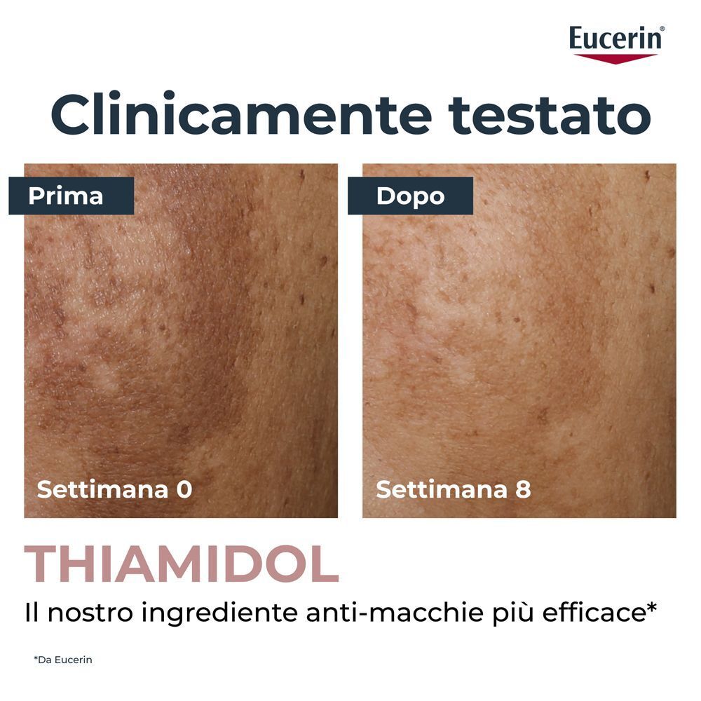 Confronto prima e dopo della pigmentazione cutanea trattata con Eucerin Anti-Pigment Siero Illuminante.