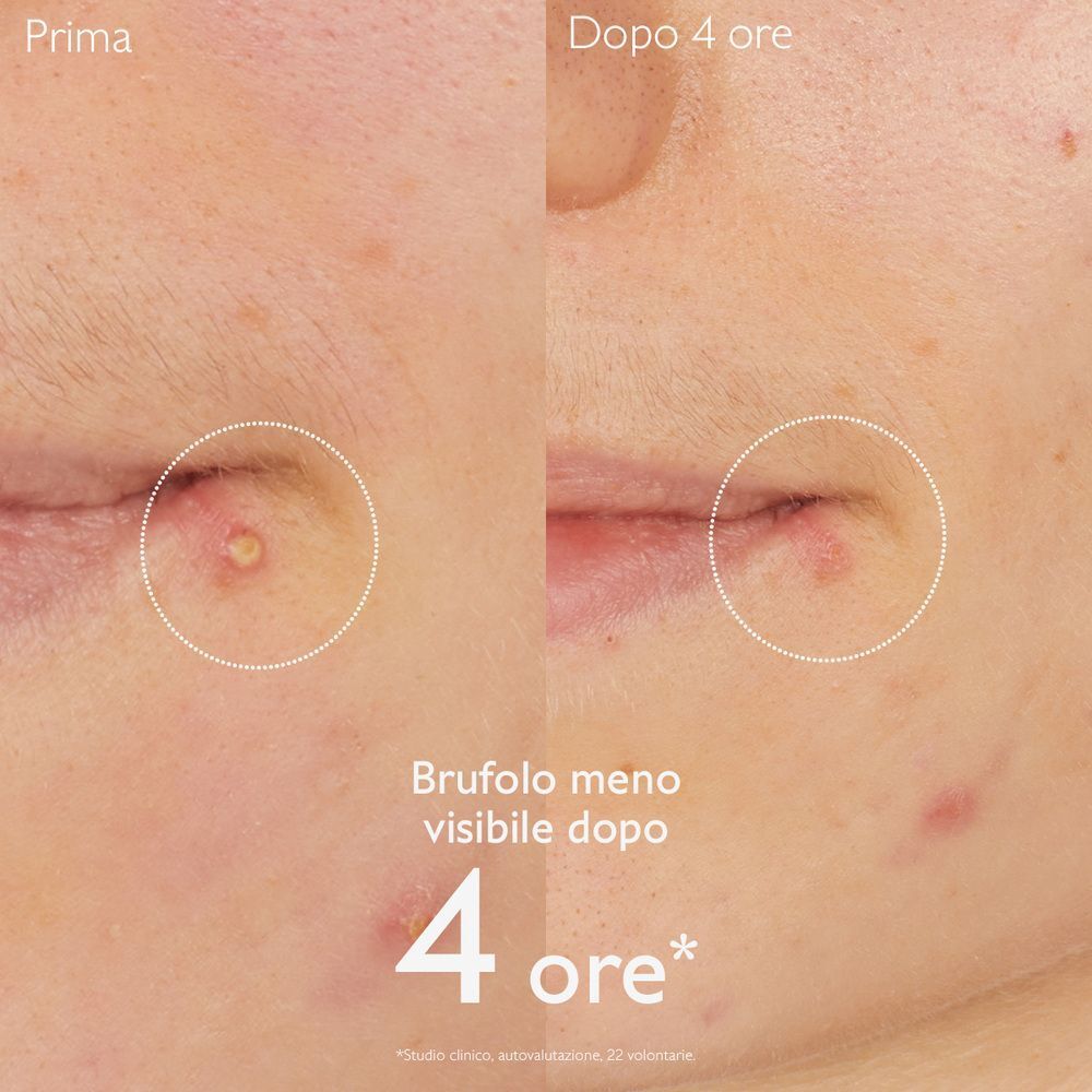 Confronto prima/dopo: un brufolo è meno visibile dopo 4 ore.