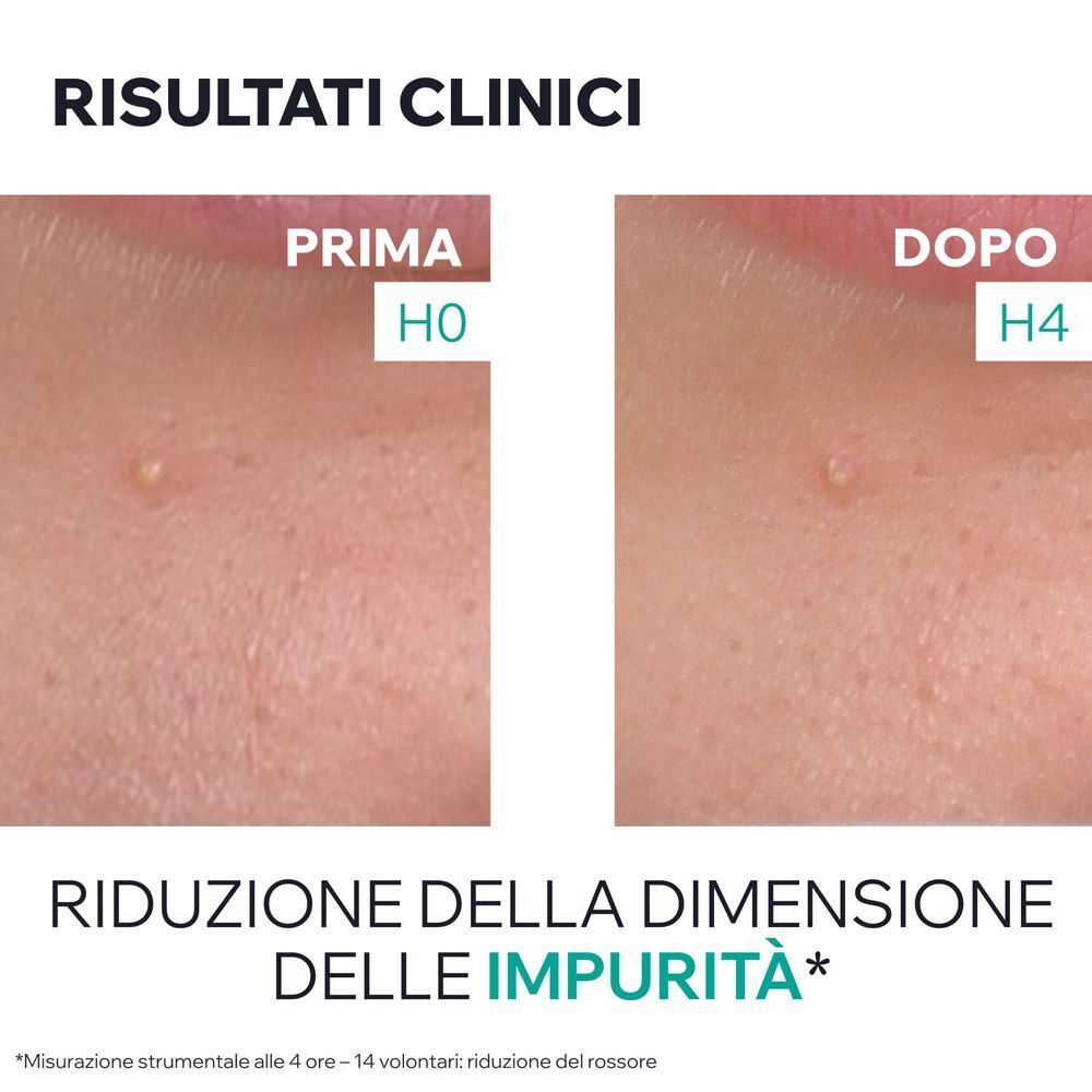 Risultati clinici: Confronto prima/dopo mostra riduzione imperfezioni in 4 ore.