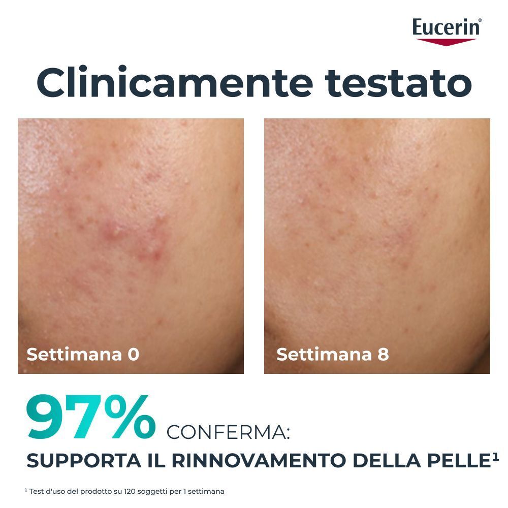 Confronto prima e dopo di pelle acneica trattata con Eucerin Dermopure Peeling 10.