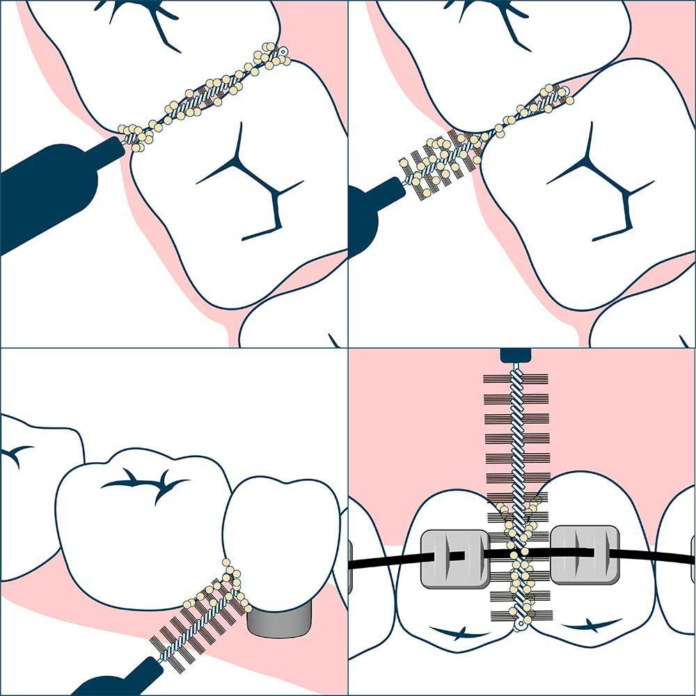 Illustrazione dell'uso di scovolini interdentali tra denti e apparecchi ortodontici.