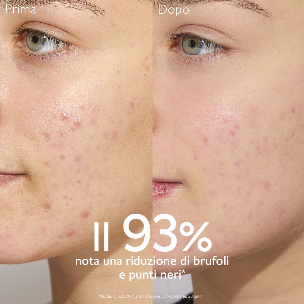 Confronto prima-dopo della pelle. 93% di riduzione di brufoli e punti neri.