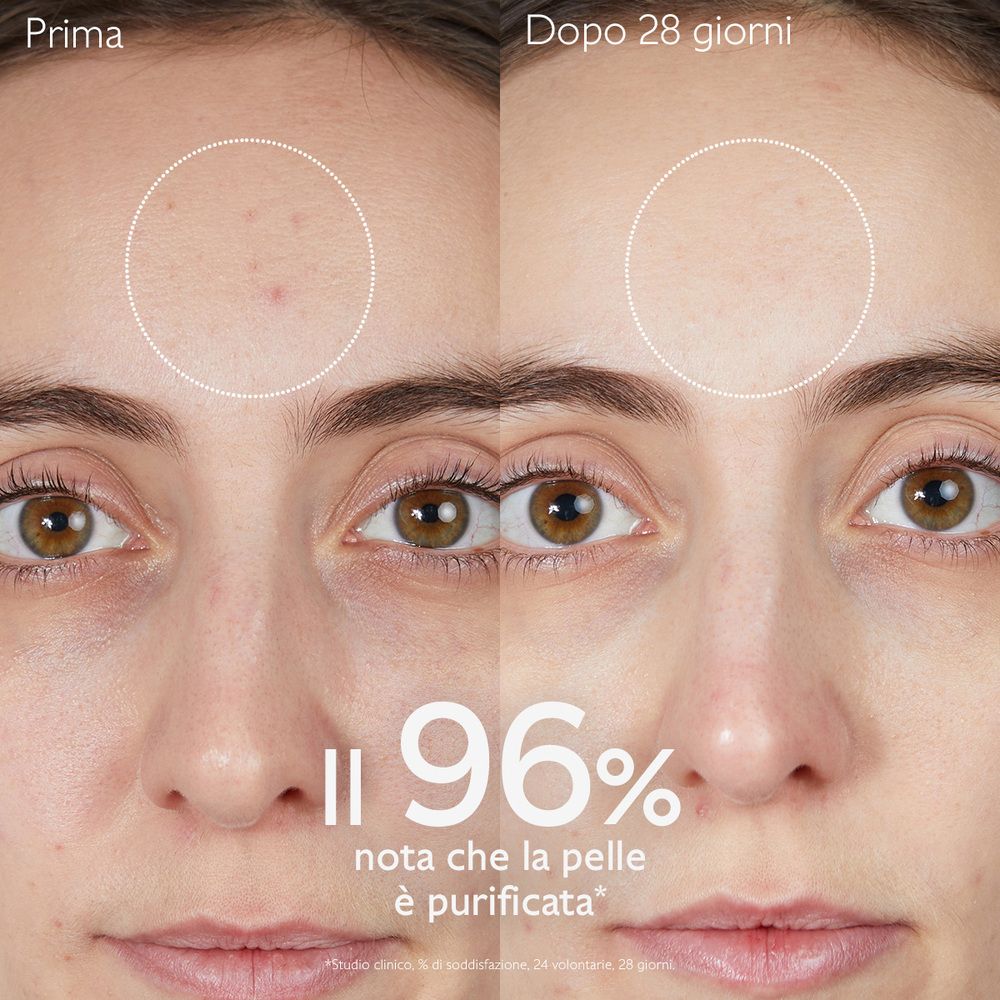 Confronto prima-dopo. Viso con brufoli. Testo: 96% nota che la pelle è purificata.