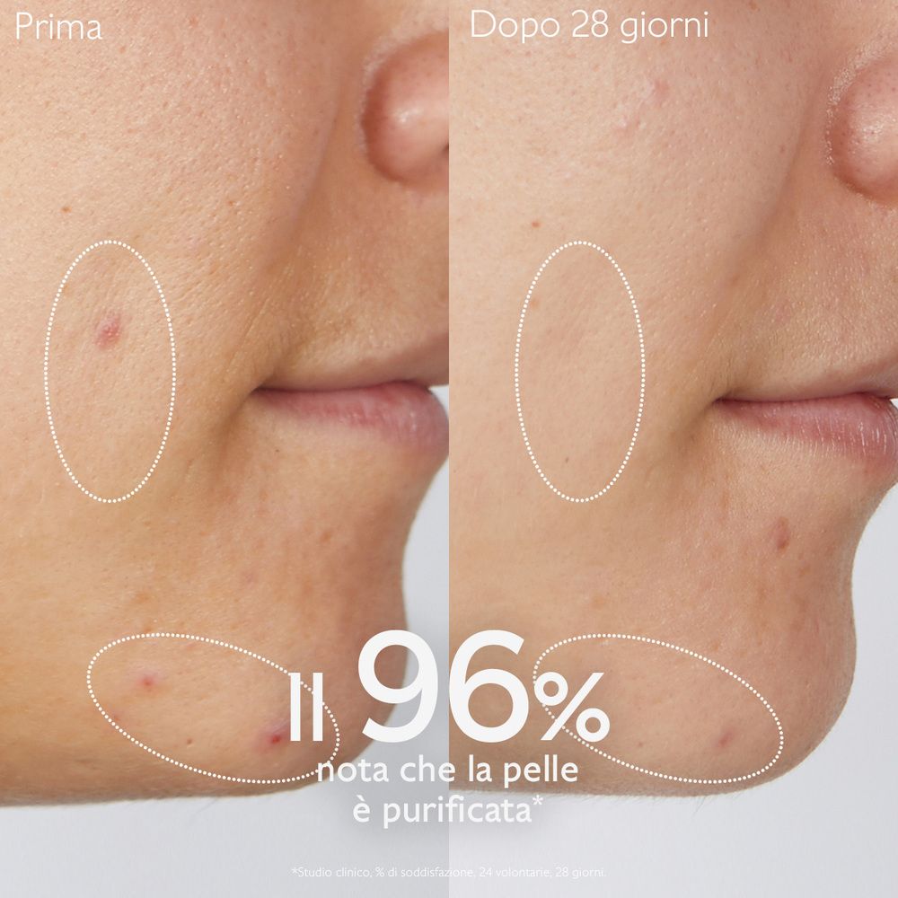 Confronto prima-dopo. Viso con brufoli. Testo: 96% nota che la pelle è purificata.