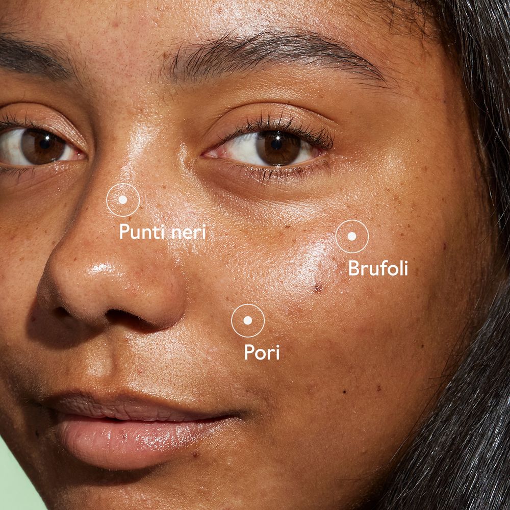 Primo piano di un viso con punti neri, brufoli e pori evidenziati. Testo in italiano.