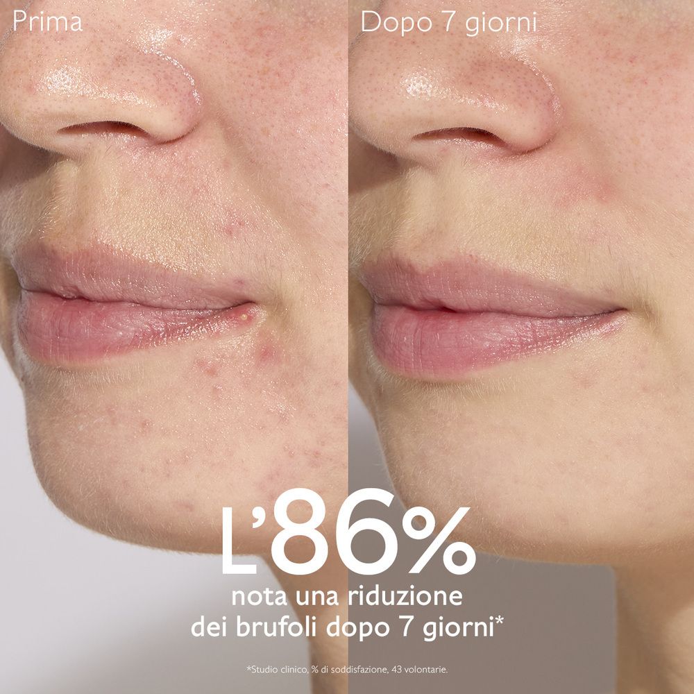 Confronto prima-dopo di un viso. Testo in italiano: 86% di riduzione dei brufoli dopo 7 giorni.