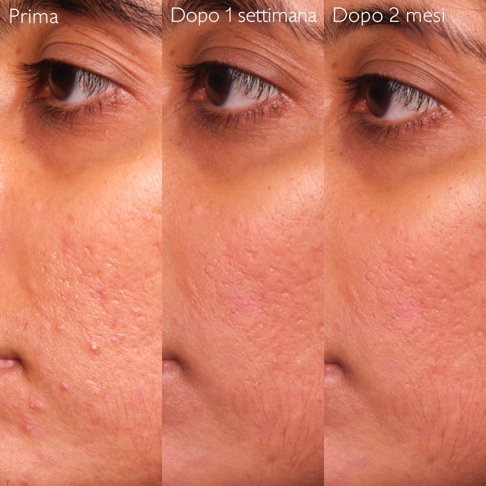 Confronto prima-dopo di un viso su 2 mesi. Testo in italiano.