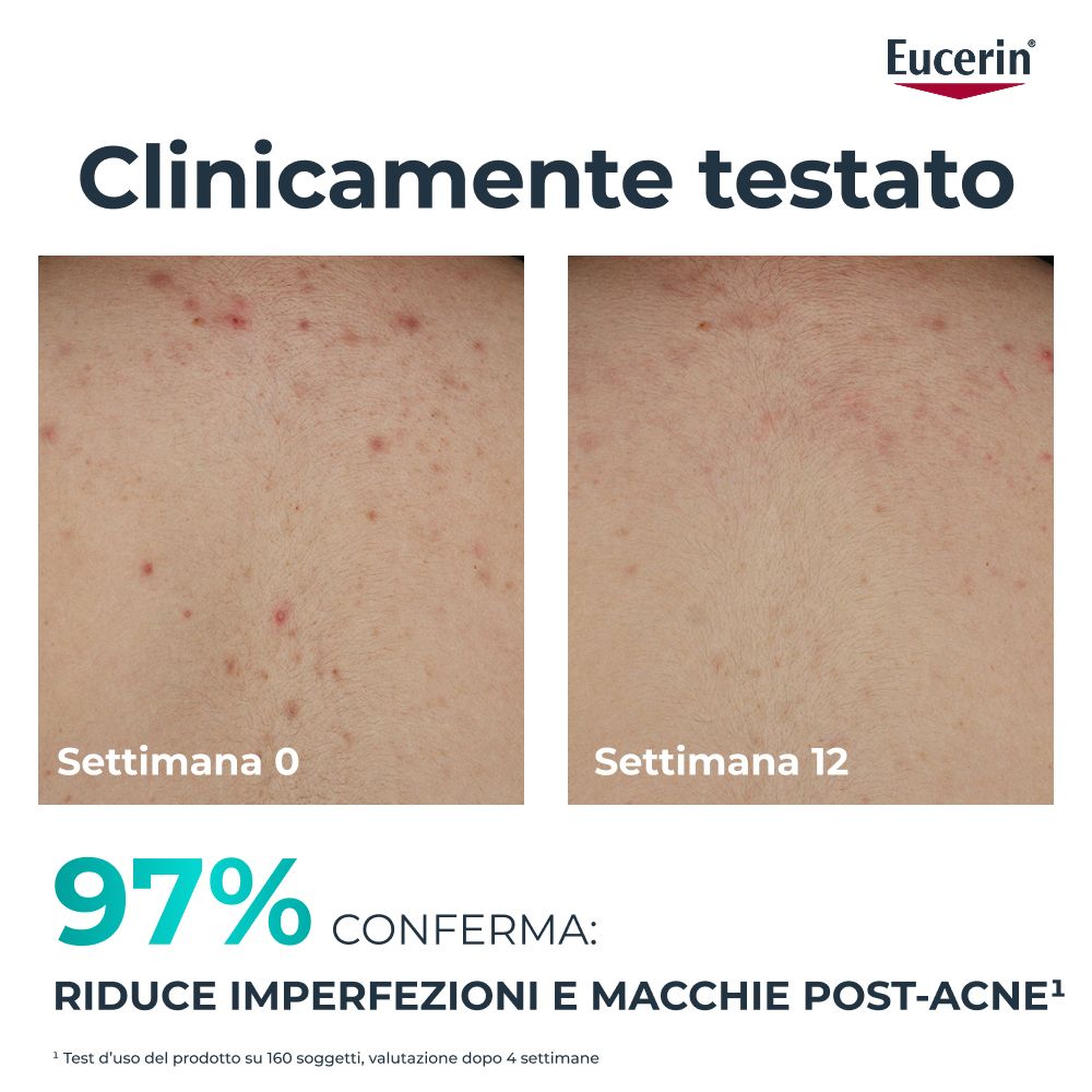 Confronto pelle: Prima/Dopo. Clinicamente testato. 97% confermano: Riduce imperfezioni e macchie post-acne.
