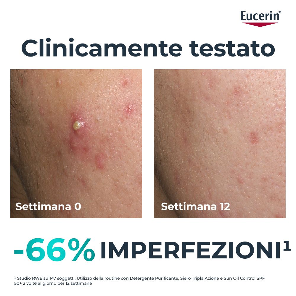 Pelle con imperfezioni prima e dopo 12 settimane. Testo: -66% imperfezioni. Logo Eucerin.