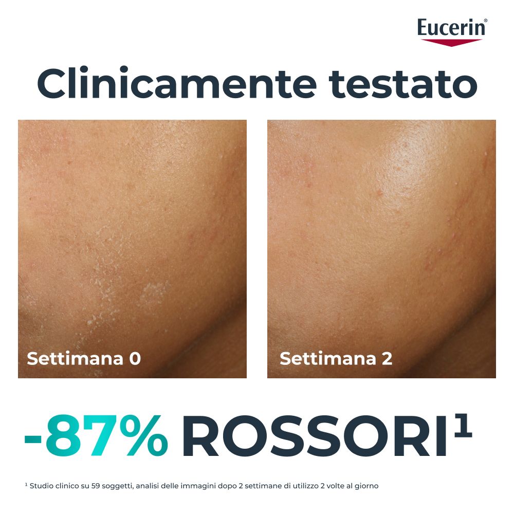 Pelle del viso prima e dopo. -87% di rossori. Logo Eucerin. Clinicamente testato.