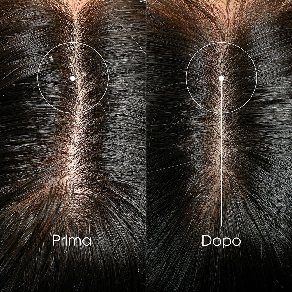Due primi piani del cuoio capelluto. Prima e dopo. Forfora visibile prima dell'applicazione.