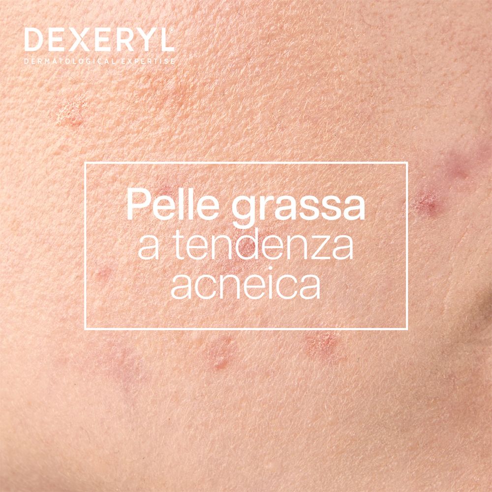Primo piano di pelle con brufoli. Testo: Pelle grassa a tendenza acneica.