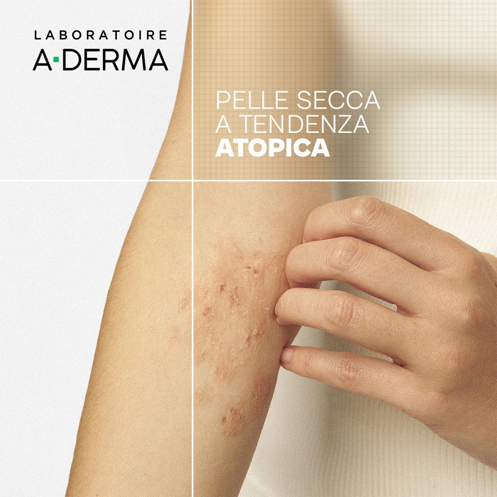 Braccio con eruzione cutanea. Testo: Pelle Secca a tendenza atopica. Logo A-Derma. Sfondo bianco.