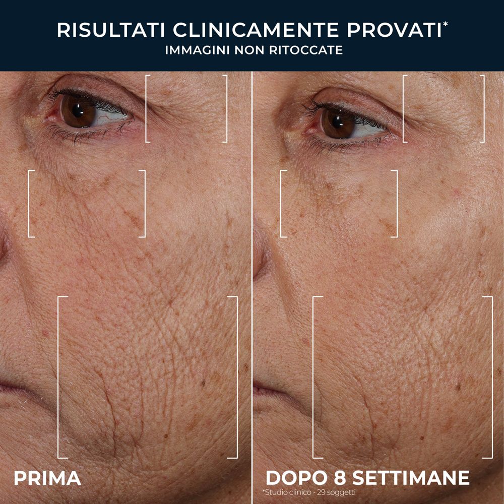 Confronto prima e dopo dell'invecchiamento cutaneo, mostra la riduzione delle rughe dopo 8 settimane.