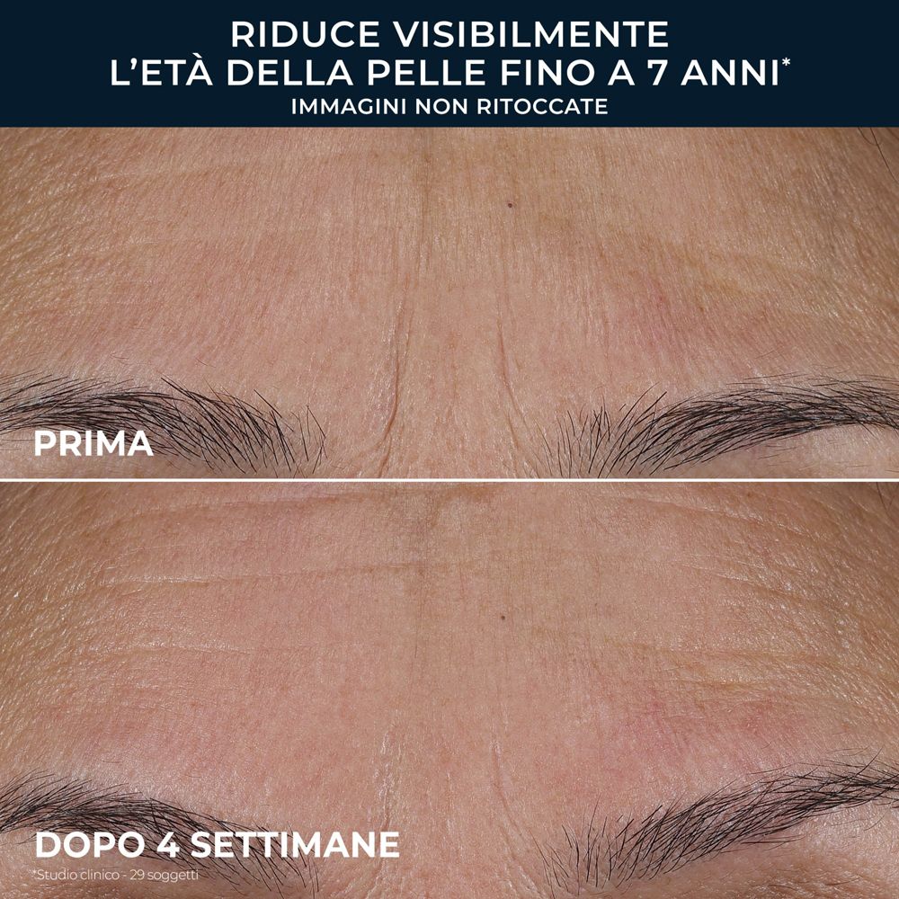 Confronto prima e dopo della pelle con riduzione delle rughe dopo 4 settimane, immagini non ritoccate.