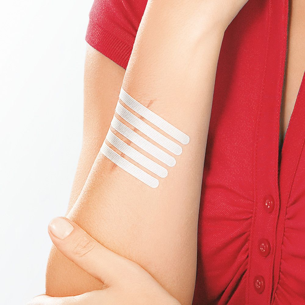 Braccio con cerotti per sutura. Strisce color carne applicate su una piccola ferita.