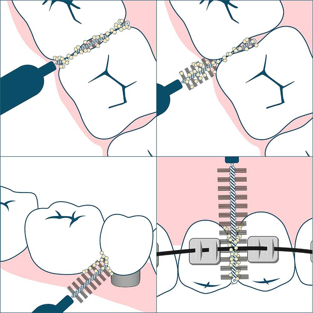 Illustrazioni sull'uso degli scovolini. Denti e spazzolini in diverse posizioni.